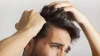 ریزش مو طبیعی یا غیرطبیعی؟ از چرخه رشد مو تا روش‌های نوین درمان